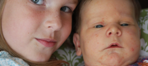 How to get rid of pimples fast for kids